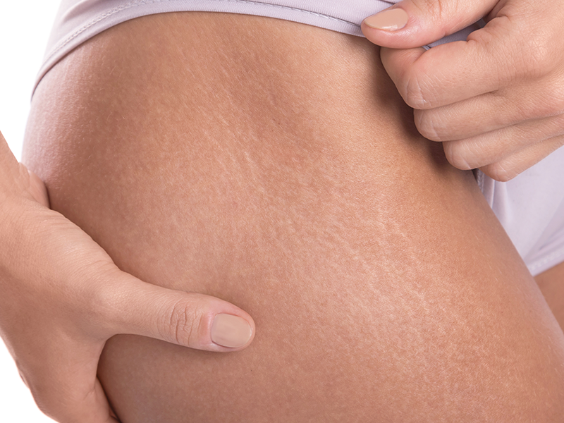 Strækmærker, løs hud og cellulite: hvad de er, og hvad de ikke er